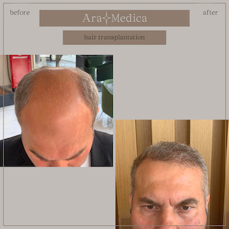 FUE before and after